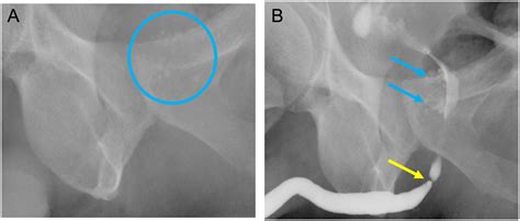 Anterior Urethral Strictures And Retrograde Urethrography An Update For Radiologists Clinical