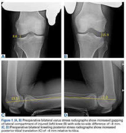 Figure 1 From Paraskiing Crash And Knee Dislocation With Multiligament