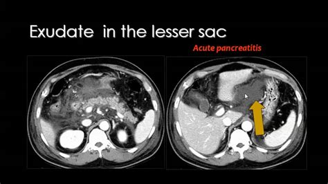 Imaging Of Peritoneal Lesions Prof Dr Mamdouh Mahfouz In Arabic Youtube