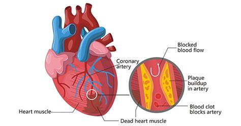 Heart Block: Types, Causes, Symptoms, And Risk Factors, 51% OFF