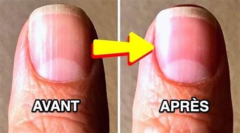 Pourquoi Mes Ongles Sont Striés Et Que Faire Pour y Remédier en