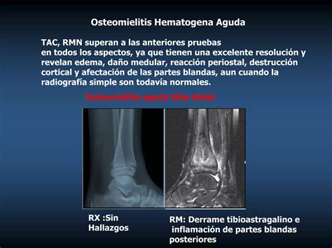 Osteomielitis Y Artritis Septica Ppt