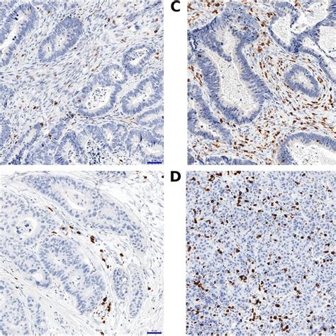 Representative Immunohistochemical Staining Of Tumor Infiltrating