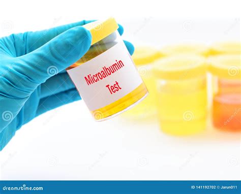 Urine Sample for Microalbumin Test Stock Photo - Image of checkup, chronic: 141192702