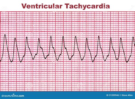 Taquicardia Ventricular Arritmia Mortal Del Corazón Stock De Ilustración Ilustración De