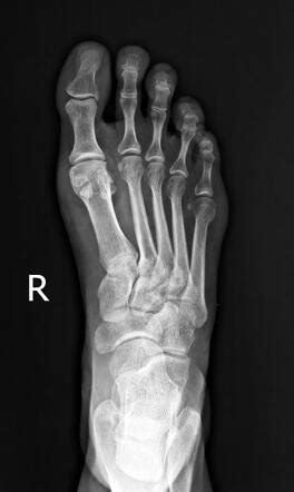 Bipartite Hallux Sesamoid Radiology Case Radiopaedia Org