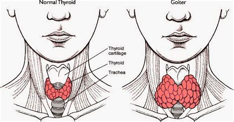 Kelenjar Thyroid