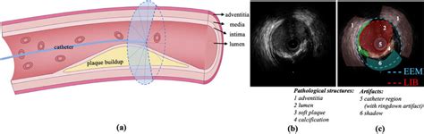 A Illustration Of The Intravascular Ultrasound Ivus Imaging Ivus Download Scientific