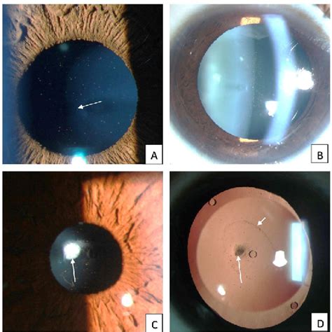 Figure From Tale Of Two Complications Following Phakic Intraocular