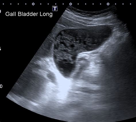 Gallbladder Sludge Radiology Case 56 OFF