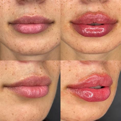 Trattamento Filler Labbra Russian Lips Studio Dentistico Ferrarini