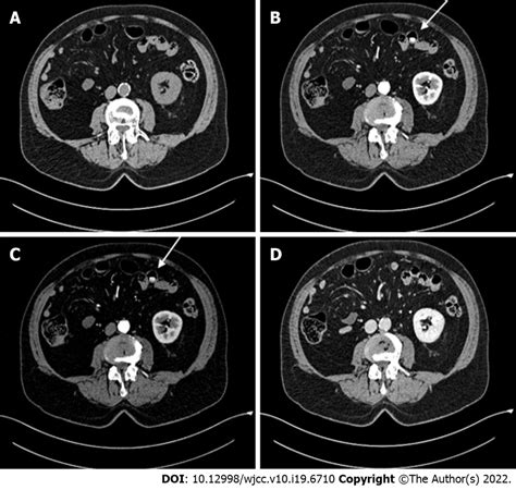 Abdominal Contrast Enhanced Computed Tomography Scan A Pre Contrast