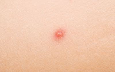 Acne Papules Causes and Treatments