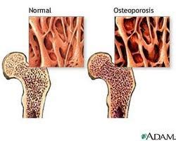 Osteoporosis - Skeletal System