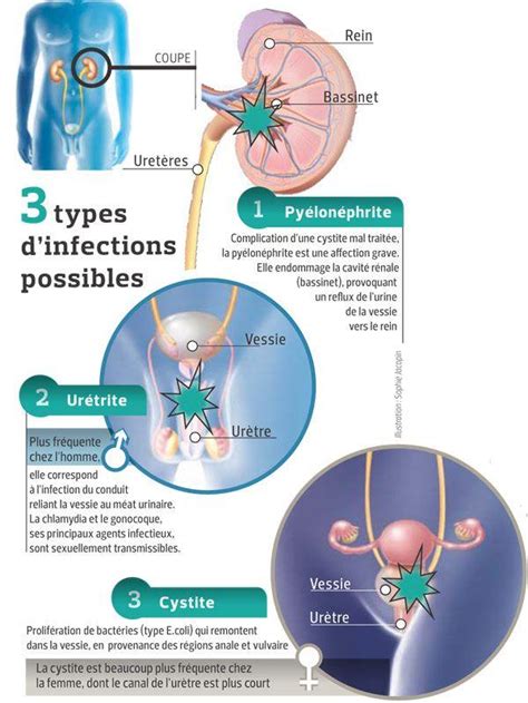 À Quoi Sont Dues Les Infections Urinaires Et Comment Les éviter