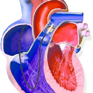 (PDF) Selective reduction of afterload in right heart assist therapy: A ...