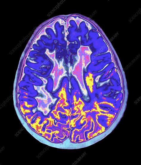 Coloured MRI brain scan showing multiple sclerosis - Stock Image - M210 ...