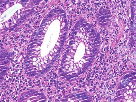 The Histopathological Findings In A Specimen From The Colon Obtained Download Scientific