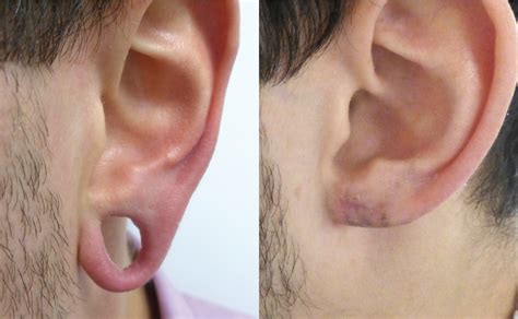 Earlobe Reconstruction Good Skin Days