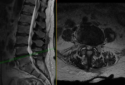 Lumbar laminectomy - Lubbock, Amarillo, Midland | Sergiy Nesterenko, M.D