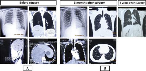 A Chest X Ray And Thoracic Computed Tomography Ct Scan With