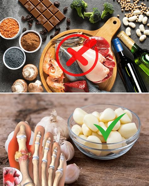 What to Eat for Gout: 12 Best Foods for Gout Sufferers