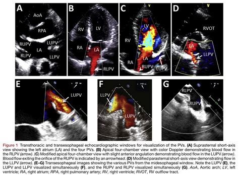 Spectral Doppler Interrogation of the Pulmonary Veins for the Diagnosis ...