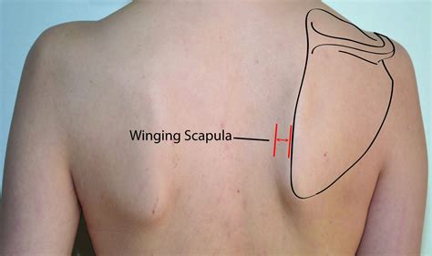 What Is Winged Scapula And How To Fix It Training For Acro T F A