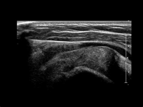 Subacromial Bursa Injection Ultrasound