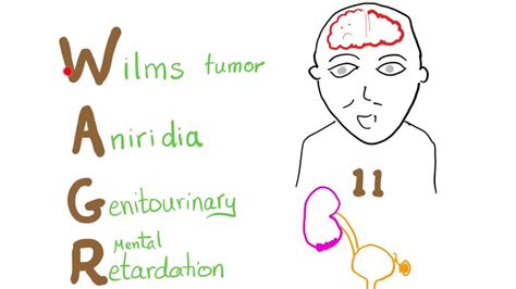 WAGR syndrome (Wilms tumor-aniridia syndrome) mnemonic! - YouTube