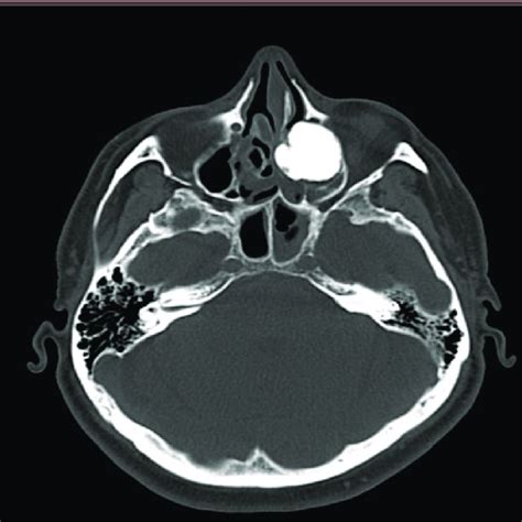 A B Paranasal Sinuses Ct Scan Showing A 50 30 30 Mm Bony Mass