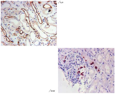 Renal Pathology And Electron Microscopy Dr Lal Pathlabs Blog