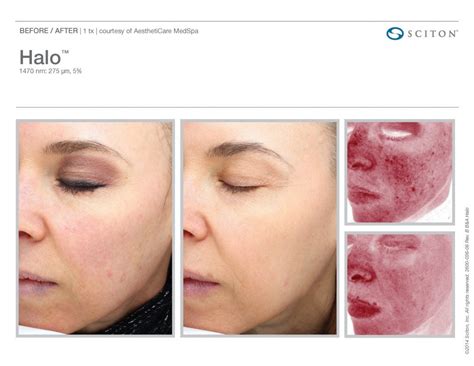 Halo Hybrid Laser Skin Resurfacing Swan Center For Plastic Surgery