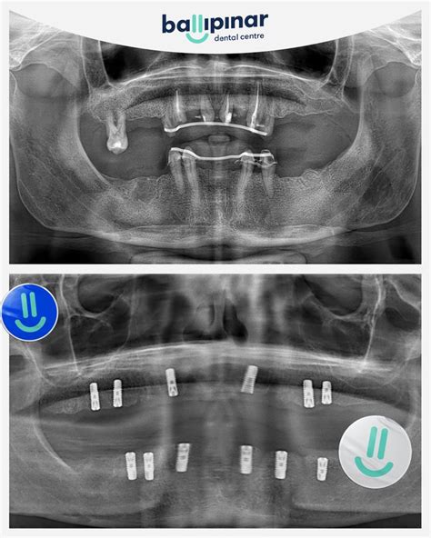 All On Dental Implants Your Gateway To A Perfect Smile In