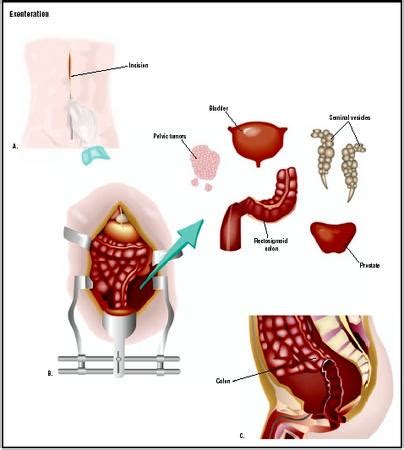 Pain Lower Left Abdomen: Colon Cancer Pain Lower Left Abdomen