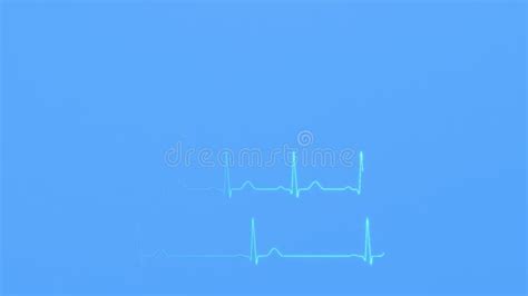 Ecg Graphs Comparison Of Normal Heart Rhythm And Arrhythmia Stock Video