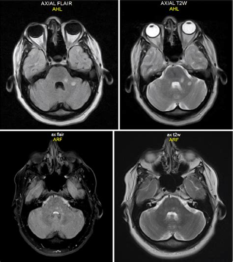 Brain Lesions Mri