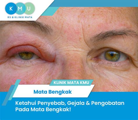 Obat Pipi Bengkak 5
