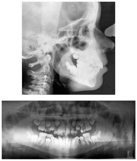 Pretreatment Radiographs A Lateral Cephalogram And Tracing B