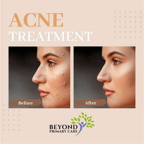 Acne Treatment — Beyond Primary Care