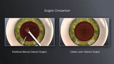 Optimedica® Catalys™ Precision Laser System For Cataract Surgery Youtube