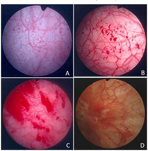 Figure 1 From Use Of Urinary Cytokine And Chemokine Levels For