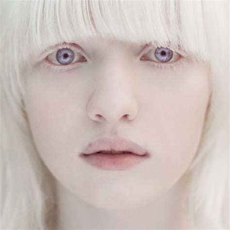 Nastya Zhidkova Albino Girl Albino Model Albinism