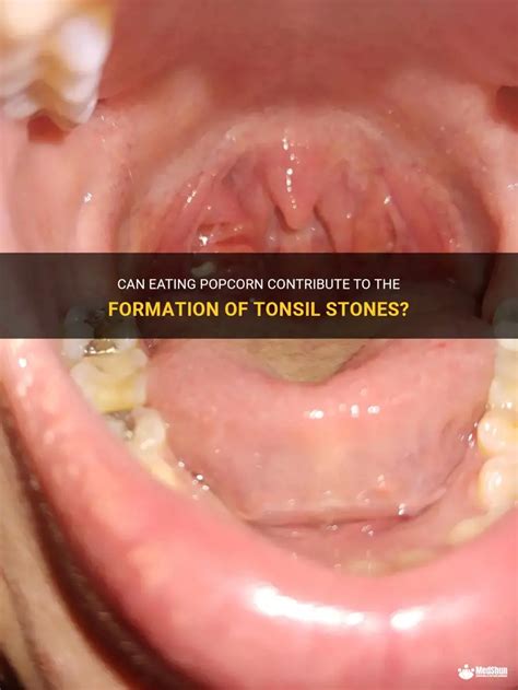 Can Eating Popcorn Contribute To The Formation Of Tonsil Stones Medshun