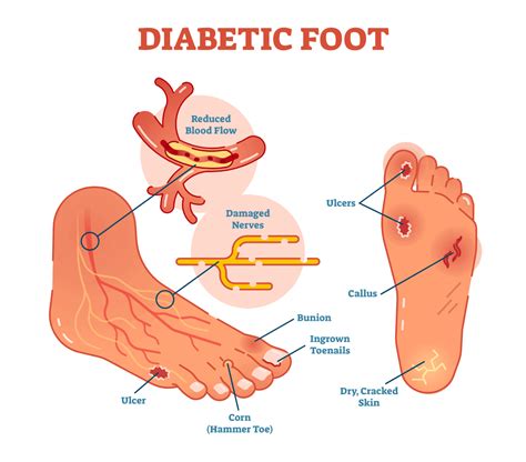 Diabetic Foot Care Tips | Preferred Foot & Ankle