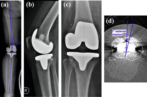 Enhanced Patella Tracking In Rotating Platform Total Knee Replacements