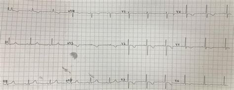 Dr. Smith's ECG Blog: Just as hyperacute T-waves can be reciprocal to T ...