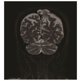 Head Ct Scan Images Show An Incomplete Bone Defect In The Left Parietal