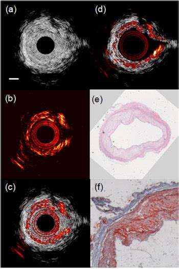 A IVUS B IVPA And C Combined IVUS IVPA Images Of An