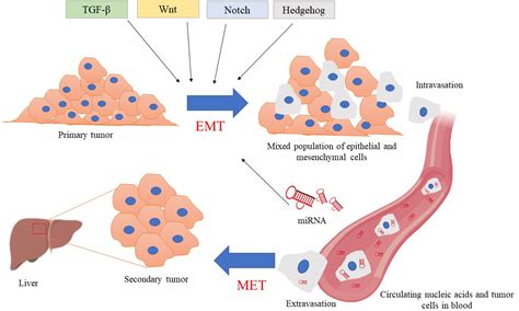 EMT In Breast Cancer Metastasis An Interplay Of MicroRNAs Signaling